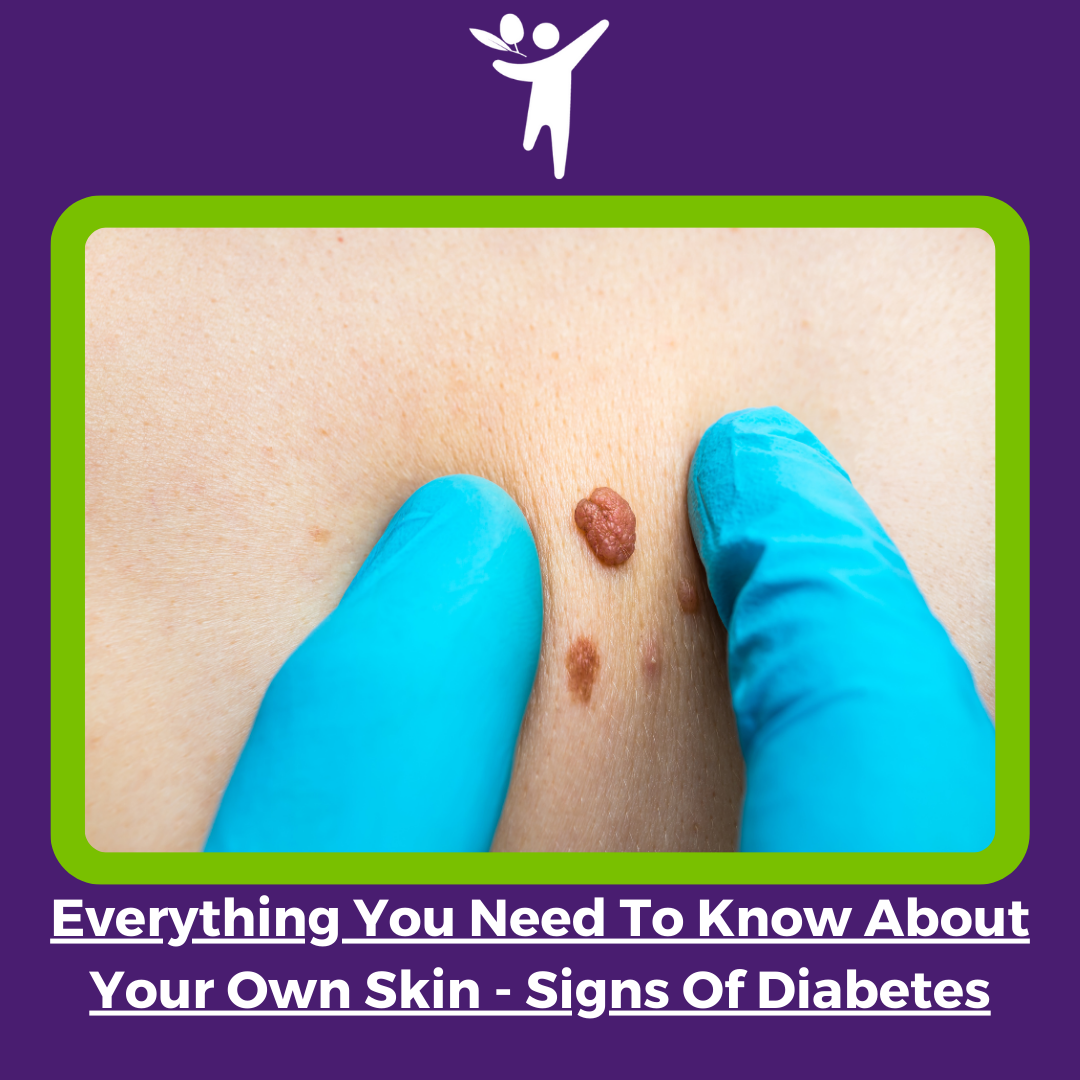 EVERYTHING YOU NEED TO KNOW ABOUT YOUR OWN SKIN – SIGNS OF DIABETES